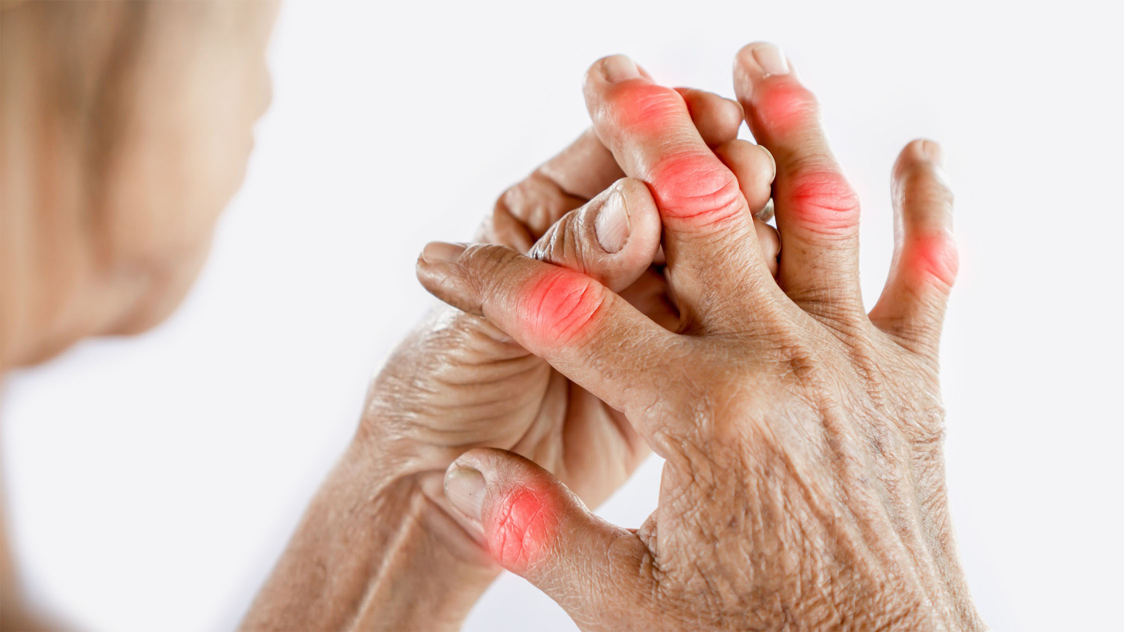 Rheumatoid Arthritis Joint Pain mbst