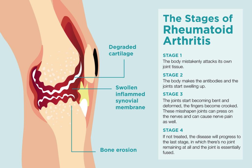 Stages of Rheumatoid Arthritis Joint Pain mbst