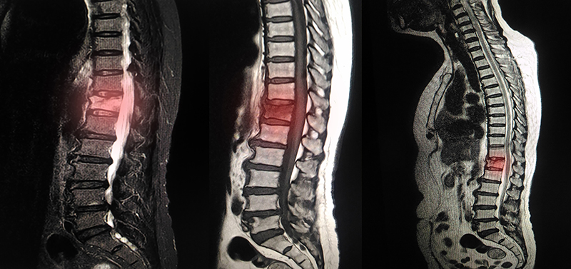 Degenerative Disc 2 mbst