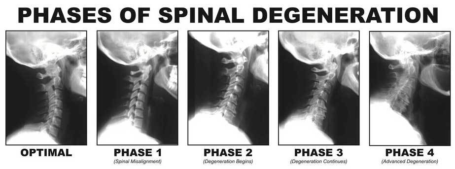 Spinal Degeneration